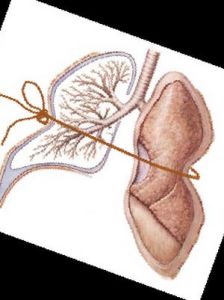 急性間質性肺炎