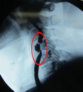 雙側頸動脈斑塊 雙側頸動脈斑塊