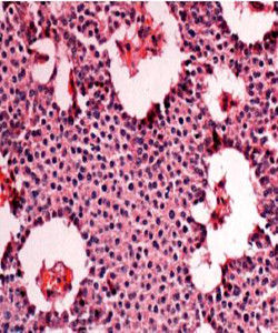 胰島素瘤 胰島素瘤