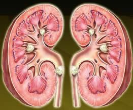 患有結石的腎臟