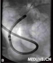 經口子母膽道鏡檢查 經口子母膽道鏡檢查