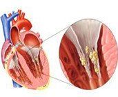 老年人心內膜炎