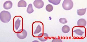 裂紅細胞