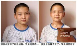 小兒斜頸 小兒斜頸