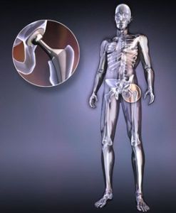 髖關節炎 髖關節炎