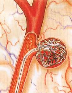 （圖）腦內動脈瘤