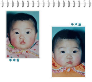 先天性唇裂 先天性唇裂