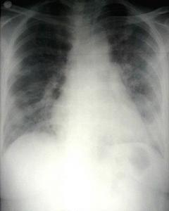 乳汁吸入性肺炎