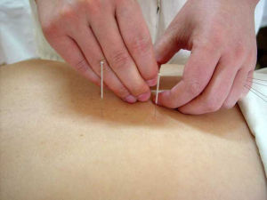 針灸美容法 針灸美容法