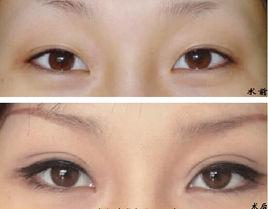 田氏雙眼皮 田氏雙眼皮