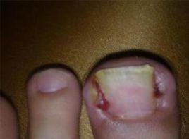 指甲凍傷 指甲凍傷