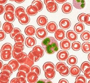 老年人高鈉血症 老年人高鈉血症