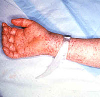 （圖）因落磯山斑點熱而引發在手臂的瘀點