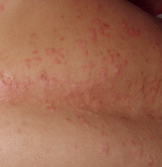 丘疹性蕁麻疹