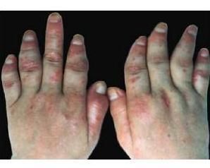 軟組織腫脹 軟組織腫脹