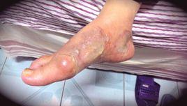 二度燙傷 二度燙傷