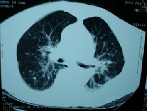 分子靶向治療 分子靶向治療