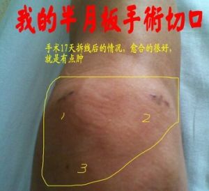 膝關節半月板損傷治療