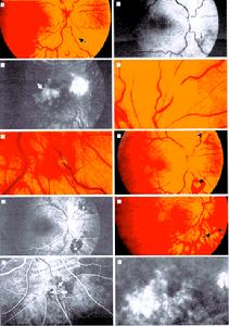 新生血管性青光眼