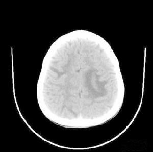 肌張力障礙綜合徵