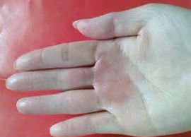 局限性多汗症 局限性多汗症