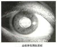 晶體鐵鏽沉著症白內障
