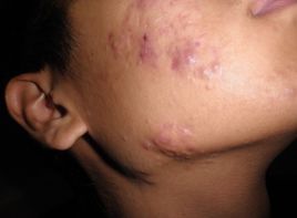 膿包型痤瘡
