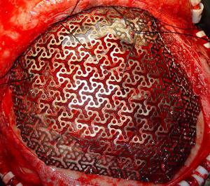 眼眶骨纖維異常增殖症