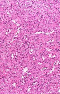 肥大細胞增生症 肥大細胞增生症