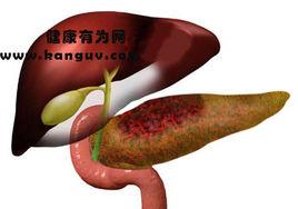 胰腺分裂症 胰腺分裂症