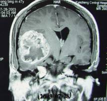 星型母細胞膠質瘤 星型母細胞膠質瘤