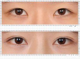 韓式無痕開眼角