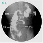 先天性巨結腸症