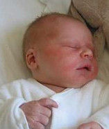 胎兒溶血症 胎兒溶血症