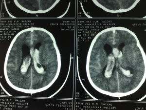 珠網膜下腔出血