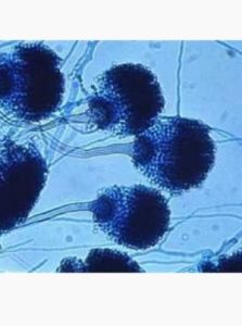 真菌性肺炎 真菌性肺炎