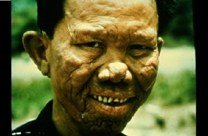 毒血症臨床表現