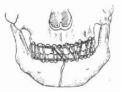 小環頜間結紮固定法 小環頜間結紮固定法