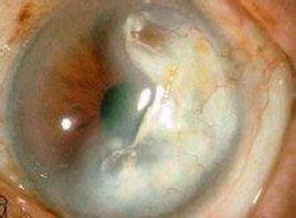 角膜晶狀體粘連 角膜晶狀體粘連