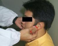 下頜關節復位 下頜關節復位