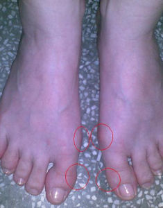 大腳趾外翻 大腳趾外翻