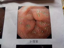 胃竇潰瘍 胃竇潰瘍