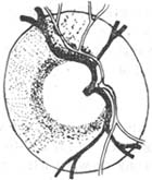 原發性開角型青光眼
