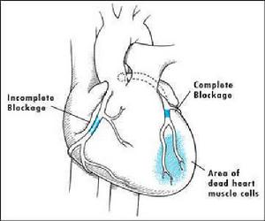 病理性陣發性室性心動過速