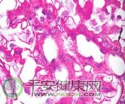 慢性間質性腎炎