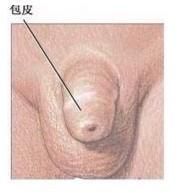 包皮粘連 包皮粘連