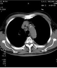 淋巴結結節病 淋巴結結節病