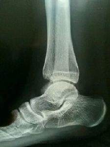 撕脫性骨折 撕脫性骨折