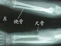 先天性尺橈骨融合