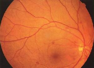 視網膜後膜